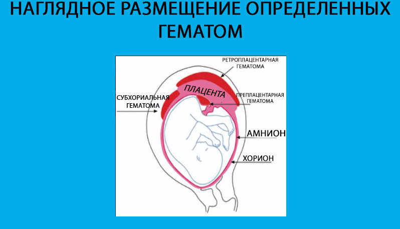 Как опорожняется гематома при беременности фото