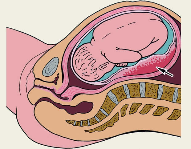 Гематома во время беременности
