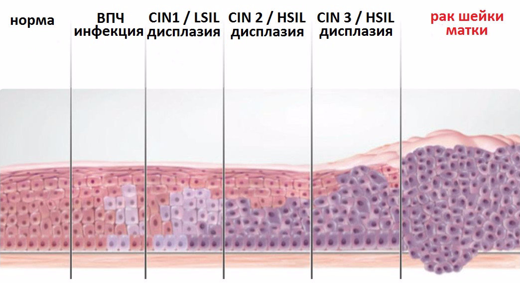 Дисплазия шейки матки на фоне воспалительного процесса