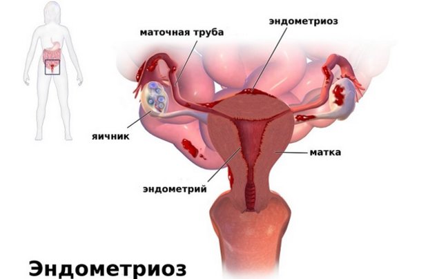 Эндометриоз у женщин