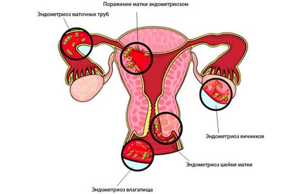 Наружный эндометриоз