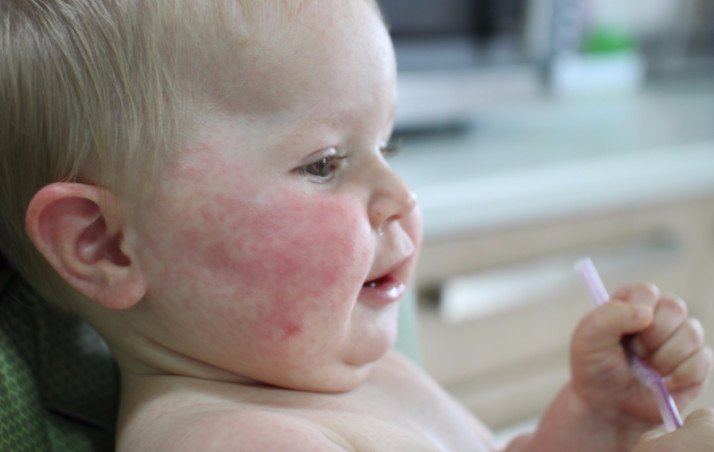 Детская розеола: причины, симптомы, лечение заболевания