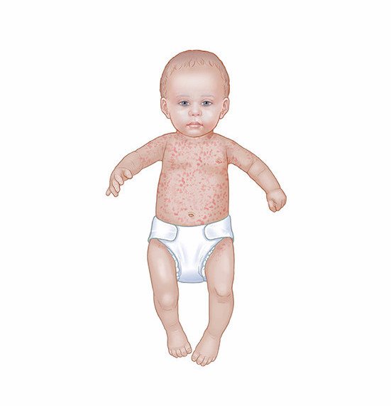 Детская розеола: причины, симптомы, лечение заболевания