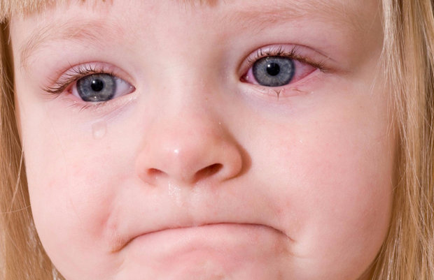 Аллергический конъюнктивит у ребёнка
