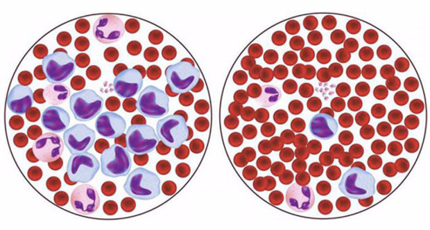 Нормальный и пониженный уровень моноцитов в крови
