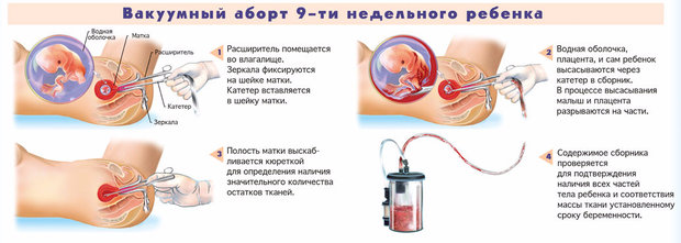 Мини-аборт