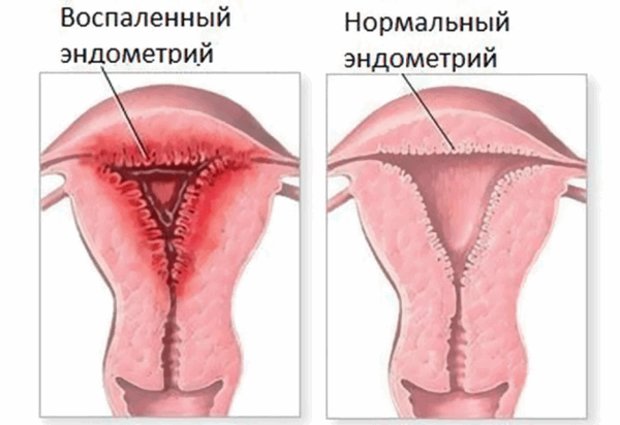Нормальный и воспаленный эндометрий