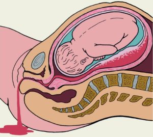 Маточные кровотечения в период беременности