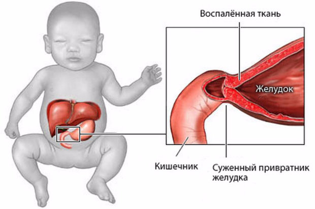 Пилоростеноз у новорожденных детей