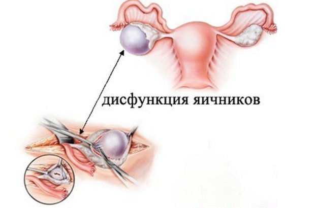Дисфункция яичников