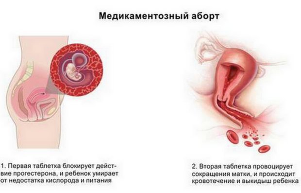 Медикаментозный аборт