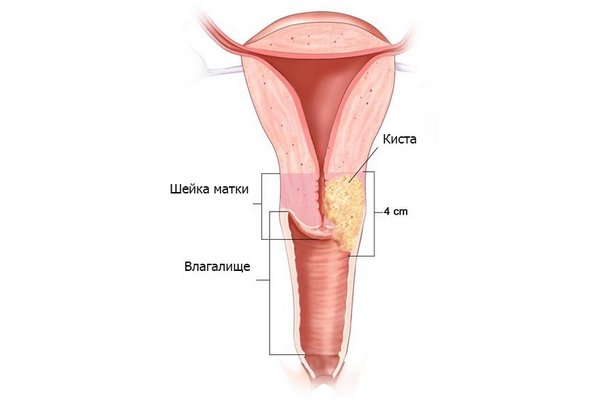 Киста шейки матки: что это, чем опасна, можно ли забеременеть, симптомы ...