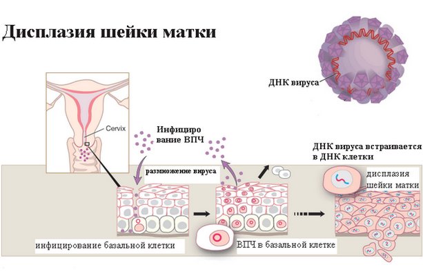 Дисплазия шейки матки картинки