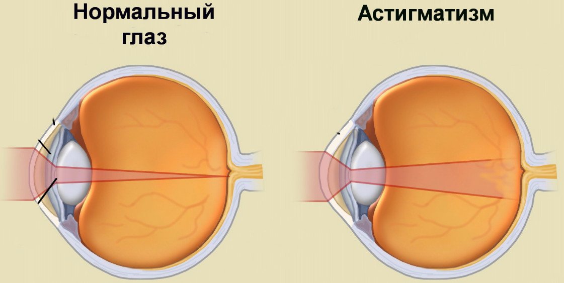 Астигматизм у детей: от чего появляется, как определить, что делать ...