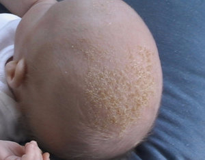 корочки на голове у младенца