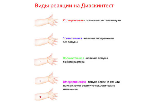 Диаскинтест екатеринбург. Диаскинтест екатеринбург