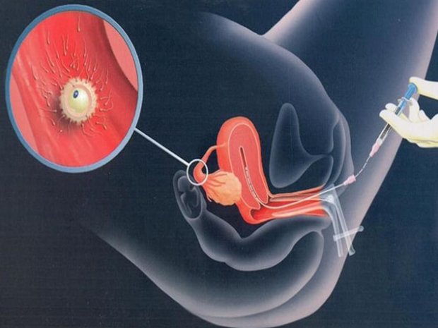 Внутриматочная инсеминация спермой