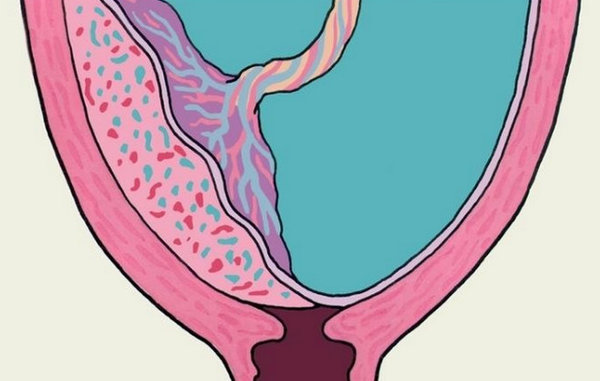 Плацента по передней стенке матки фото