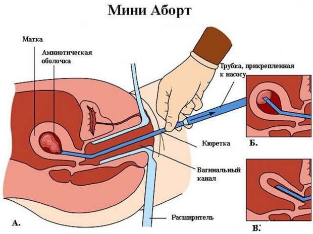 Вакуумный мини-аборт
