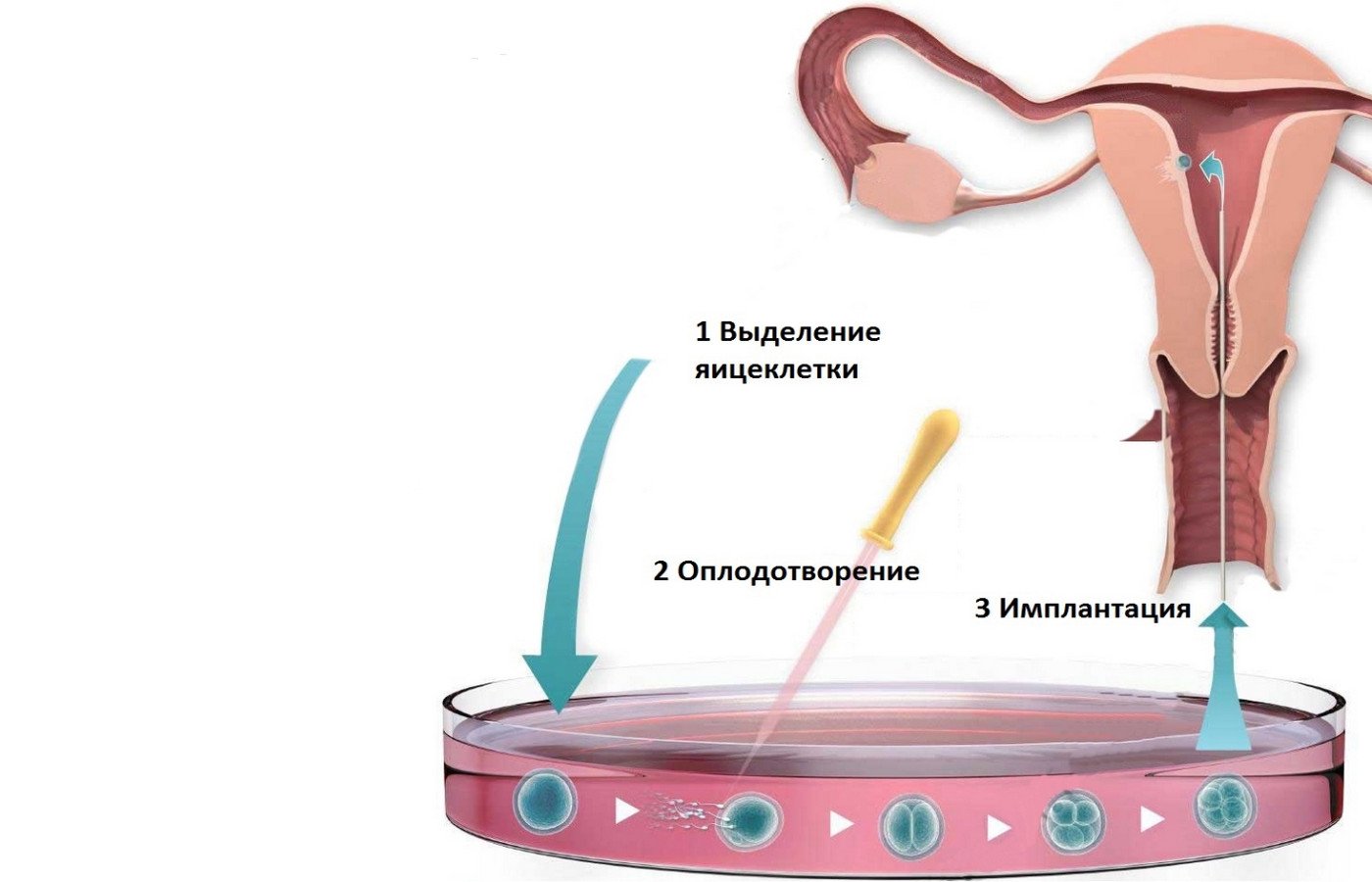 Как делают ЭКО: описание от начала до конца, этапы проведения по дням ...