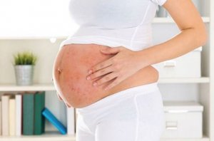 Экзема при беременности