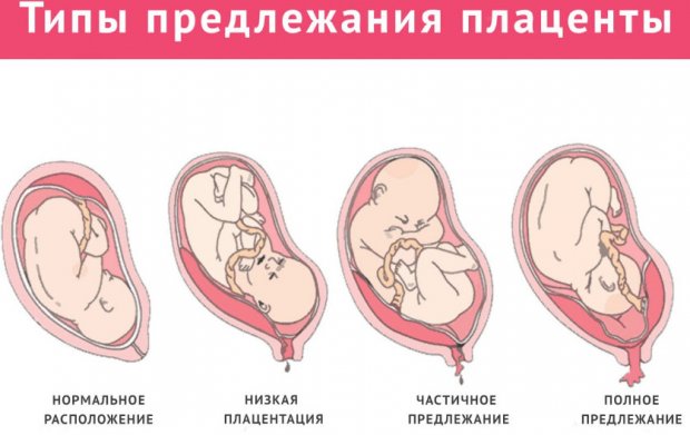 Предлежания плаценты