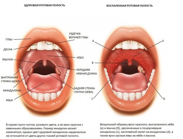 Как определить больное горло