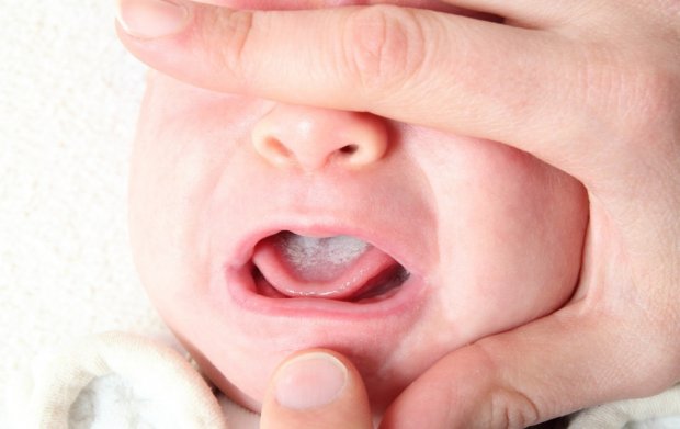 Молочница во рту у младенца